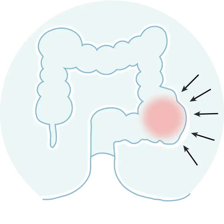Constipation Treatment