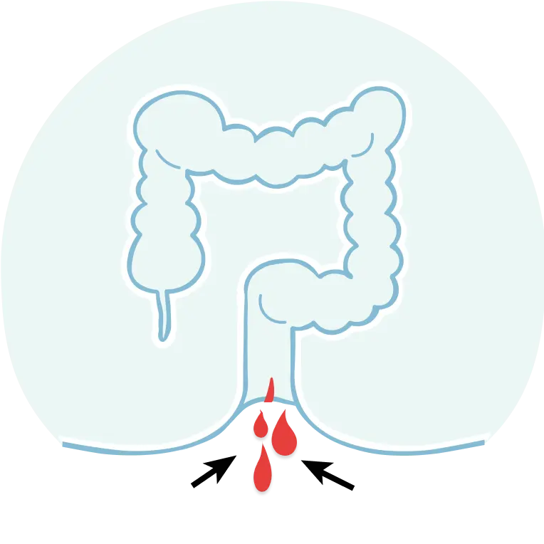 Fistula treatment