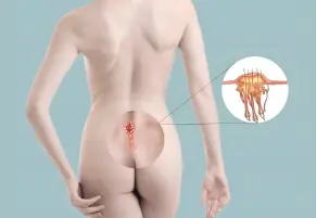 Pilonidal Sinus Treatment